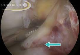 4.6 ab wann kann ein hund nach einer kreuzband op wieder laufen? Kreuzbandriss Operation Durch Zusammenheilen Der Fragmente Oder Sehnen Transplantation Gelenk Klinik De