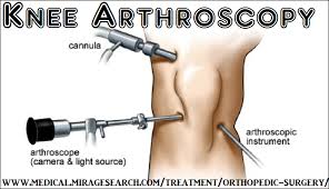 Orthopedics Treatments Knee Arthroscopy Arthroscopic Knee Surgery Knee Surgery Knee Arthroscopy