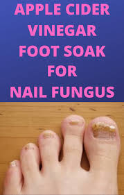 Anyone interested in trying vinegar can apply vinegar directly to the affected nails by soaking the toes in a bowl of warm water mixed with vinegar. Apple Cider Vinegar Foot Soak For Nail Fungus It Works