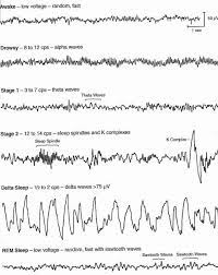 Eeg Readings Sleep Medicine Rem Sleep Neurofeedback Therapy
