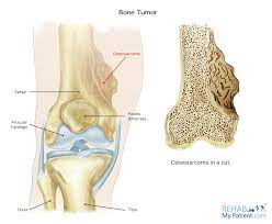 About 30 children in the uk develop osteosarcomas each osteosarcoma often starts at the end of the long bones, where new bone tissue forms as a young. Osteosarcoma Rehab My Patient