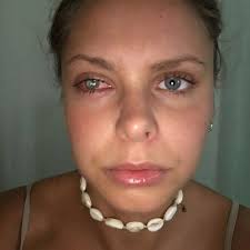 Personal trainer half-blinded after she got a bacterial infection from her  dirty make-up bag