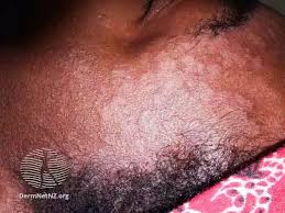 Image result for Seborrheic Dermatitis