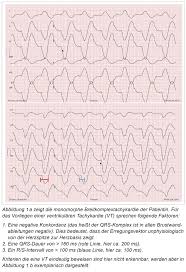 Myocarditis presenting acutely is an inflammatory disease of the myocardium. Bayerisches Arzteblatt