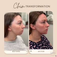 DESIREE MOSER, RN (@injector_desiree) • Instagram फोटोहरू र भिडियोहरू