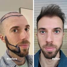 Donor Area = Preserved and Thick 🤩🤩 (Swipe to the 3rd slide!)  #hairgrowthhacks #hair #barberstyle #hairjourney #hairlosshelp  #hairtransformations #hairgoals #hairtreatment #beforeandafter