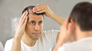 You may have heard of male pattern. Alopecia Causes Symptoms Treatments For Hair Loss And Balding Live Science