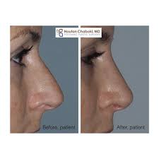 However the procedure may be provided on the nhs if it's needed the cadogan clinic is currently open for all appointments. Reducing A Bump With Preservation Rhinoplasty