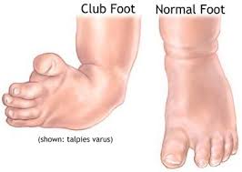 If your child has clubfoot, here's what it might look like. Clubfoot Causes Symptoms Diagnosis And Treatment Natural Health News