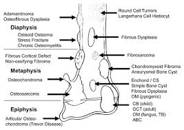 The most common types of malignant primary bone tumors are: Bone Tumors And Tumorlike Conditions Analysis With Conventional Radiography Radiology
