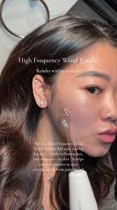 Radio Frequency Acne Before and After