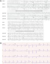 What does svt stand for? Supraventricular Tachycardia Triggering Polymorphic Ventricular Tachycardia Heartrhythm Case Reports