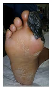 PDF] Retrograde dorsalis pedis angiosomal flow compromised by small  puncture wound leading to transmetatarsal amputation.