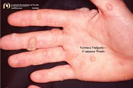 Image result for verrucae filiformes