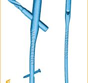 PFNA Nail Uses, Sizes & Surgical Techniques • Vast Ortho