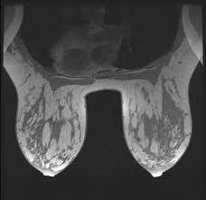 In contrast with bone scans, which are only able to detect bone metastases, pet/ct has the advantage of concurrently imaging other common sites of breast cancer metastases such as the liver and lungs, says lead author patrick morris, a breast cancer specialist at memorial sloan kettering. Breast Mri