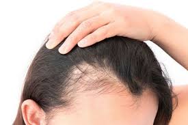 The hormonal changes initiated by spironolactone can cause a telogen effluvium. Female Pattern Baldness Symptoms Causes And More