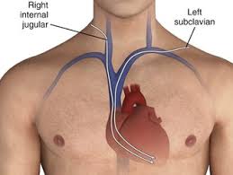 Image result for Transcutaneous Pacing