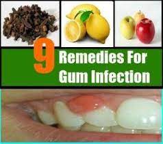9 Best Home Remedies For Gum Infection Gingivitisgingivitistreatment Gum Disease Remedies Gum Disease Treatment Gum Disease