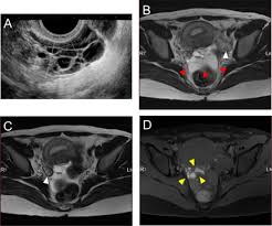Endometriosis is a disease in which tissue similar to the lining of the uterus grows in other places in the body outside of the womb. An Unusual Imaging Appearance Of Peritoneal Endometriosis Presenting A Pelvic Multilocular Tumor Journal Of Minimally Invasive Gynecology