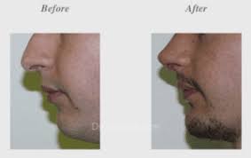 Fixed an issue with lodash 4 compatibility related to behavior events. Facial Implants Vs Fillers Renato Calabria Md Facs