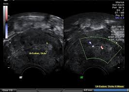Teuer, unklare wirkung endometriosezyste bei beschwerdefreier patientin eher nicht operieren hysteroskopie ohne auffälligen befund im ultraschall. Vaginalsonografie
