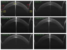 My wife and i have been on restasis for many years with fabulous results. Tear Menisci Before And After 2 Months Of Restasis Treatment Notes Download Scientific Diagram