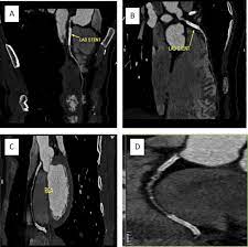 If you want to see other. Value Of Triple Rule Out Ct In The Emergency Department Sciencedirect