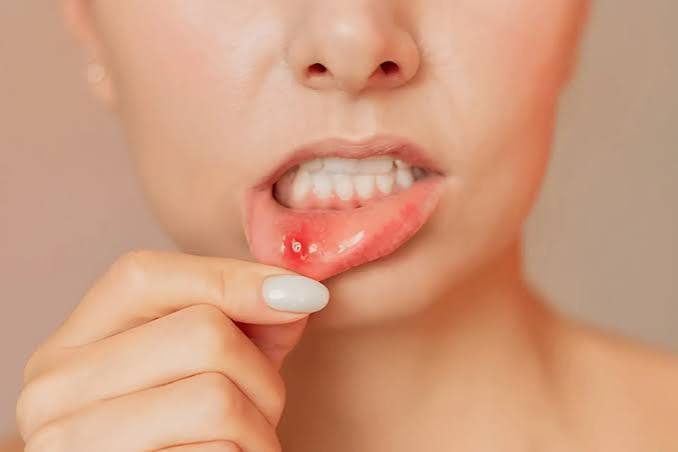 Mouth Ulcers: Causes, Symptoms & Treatment For Fast Relief