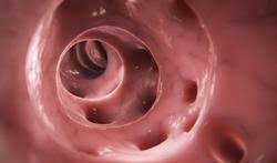Diverticulite Quand Peut On Se Soigner A La Maison Passionsante Be