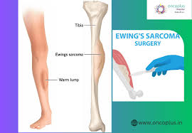 Image result for Ewing Sarcoma