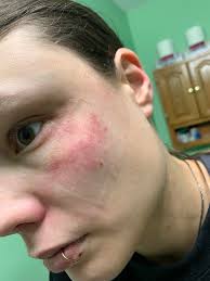 Hello everyone. My name is Laura and this is my 17th case of shingles