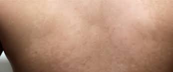 بقع بيضاء في الظهر ما تفسيرها ويب طب