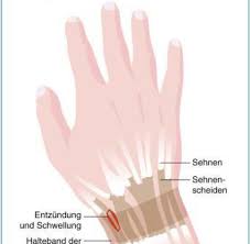 Uberbelastung Mit Der Pech Regel Gegen Sehnenscheidenentzundung Welt