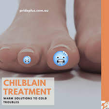 Image result for Chilblains