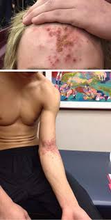 The clinical herpes pictures on this page may be disturbing to some people. Skin Infections In Athletes Orthoinfo Aaos