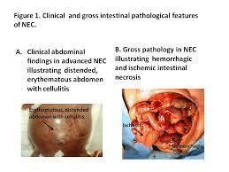 Necrotizing Enterocolitis Cancer Therapy Advisor