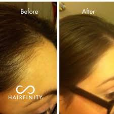 Biotin is a vitamin that helps your body break down fats, carbohydrates, and proteins, and if you don't have enough of it, it can lead to hair loss. Buy Hairfinity Hair Growth Oil Serum And Vitamins With Biotin Hair Growth Treatment To Prevent Hair Loss And Stimulate Hair Follicles To Stop Hair Loss And Regrow Hair Targets Causes