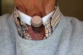 Hpv Throat Cancer Survival Rate Ifhnos Auckland 2016