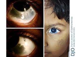 Image result for nevus sclerae