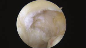 High Grade Partial Thickness Articular Surface Supraspinatus Tear With Download Scientific Diagram