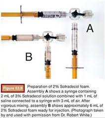 The solution has the consistency of shaving cream; Varicocele Clinical Applications Embolization Therapy Principles And Clinical Applications 1 Ed