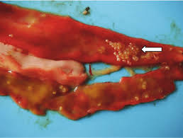 Catarrhal inflammation definition at dictionary.com, a free online dictionary with pronunciation, synonyms and translation. Catarrhal And Hemorrhagic Inflammation Of An Autopsied Sample Of The Download Scientific Diagram