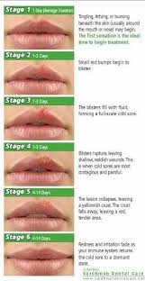I've had a nasty cold sore for 4 days now, and since yesterday it has an ugly scab over it. Cold Sore Stages Cold Sore Stages Cold Sore Cold Sore Prevention