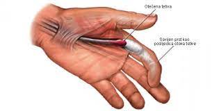 Nelečena upala tetive na ruci može preći u hronični zapaljenjski proces koji se kasnije teže leči i iziskuje dosta vremena dok ne dođete do željenog rezultata. Ako Primijetite Ovakvo Nesto Na Zglobu Ruke Odmah Idite Ljekaru Razlog Je Uzasan Novi Ba