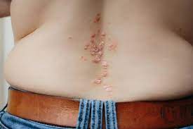 Back view of woman with dermatitis problem of rash and itchy dry skin. —  Stock Photo ? ternavskaia.o@gmail.com #432066924
