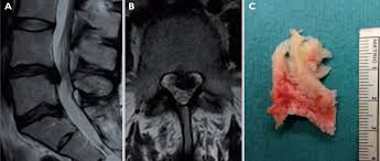 Chirurg ortoped jawad latif, domana cristina stefan. Hernie Discale Lombaire Diagnostic Et Prise En Charge Revue Medicale Suisse