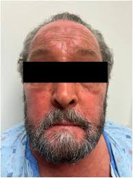 Refractory mogamulizumab-associated rash responding to an oral Janus kinase  inhibitor