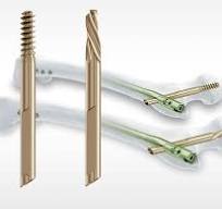 TFN-ADVANCED Proximal Femoral Nailing System (TFNA)