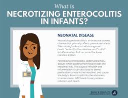 Image result for Necrotizing Enterocolitis